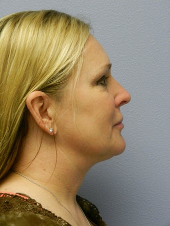 Laser Liposuction 555894