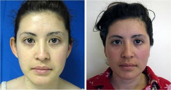 Otoplasty before 512855