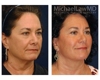 Facial Rejuvenation after 395208