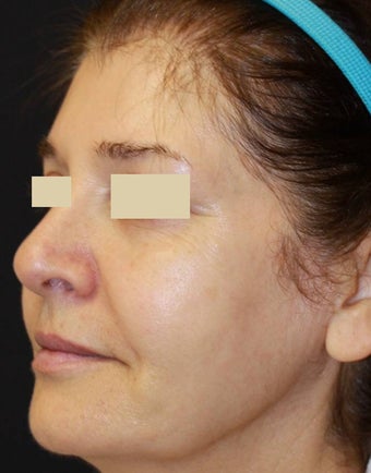 Sculptra Liquid Lift after 137158