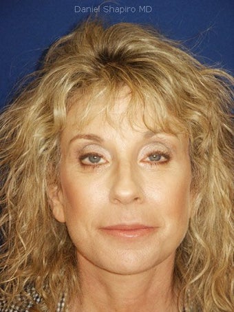 Facelift, Endoscopic Browlift, Upper and Lower Blepharoplasty, Perioral Dermabrasion, Fat injections to the Upper and Lower Lips after 249128