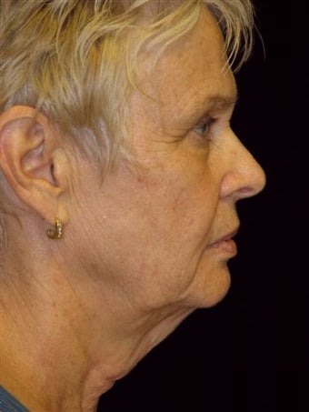 Lower Face lift before 262784