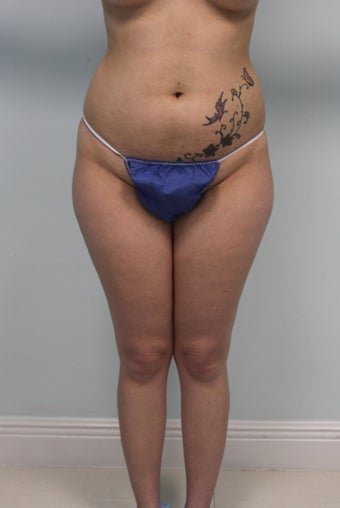 Brazilian butt lift before 360304
