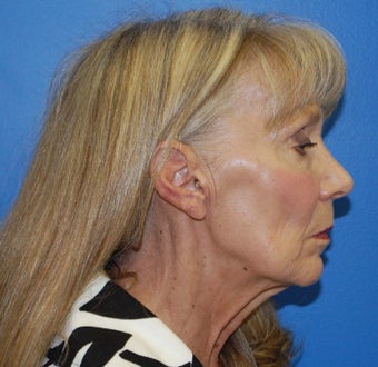 Facelift before 227947