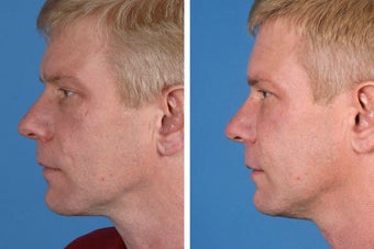 Radiesse, Restylane, Juvederm Plus & Botox Cosmetic 356492
