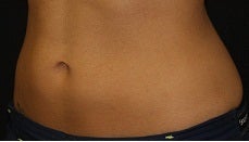 Coolsculpting-lower abdomen after 445738