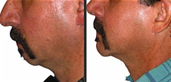 Chin Augmentation before 246965