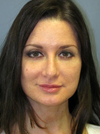 Neck Lift, Platysmaplasty after 634730
