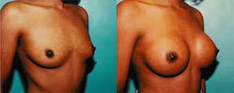 Breast Implants before 192130