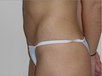 Tummy Tuck 410415