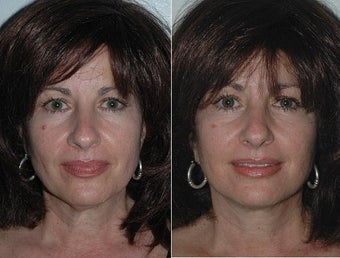 Facelift before 472172