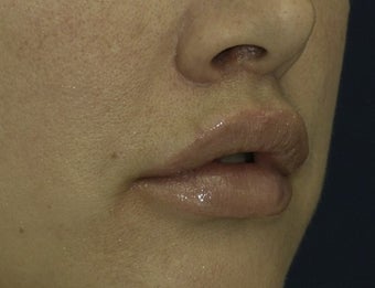Lip Lift after 615879