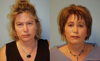 Facelift, Full Face Co2 Laser Resurfacing, Fat Transfer, Upper and Lower Blepharoplasty, Browlift before 326795