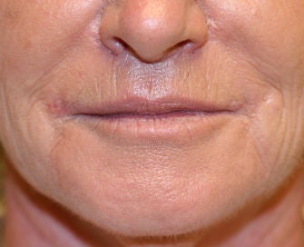 Lip lift, corner of lip lift after 299923