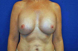 Breast Implants after 241838