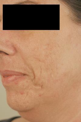Laser Acne Scar Removal after 82939