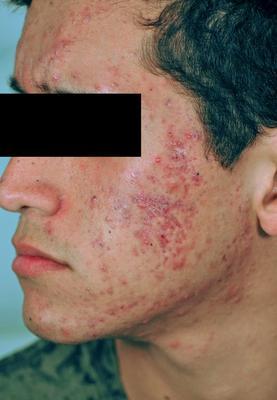 Laser Acne and Acne Scar Treatment before 82968