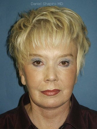 Facelift, Endoscopic Browlift, Upper and Lower Blepharoplasty with canthopexy, Perioral and Glabellar Dermabrasion after 248864