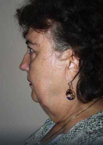 Refresher Facelift w/Neck Plication, Browllift, Upper & Lower Lids, Fat Injections to Cheeks & Lips before 252881