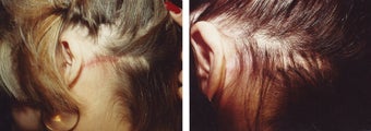 female hair transplant before 369168