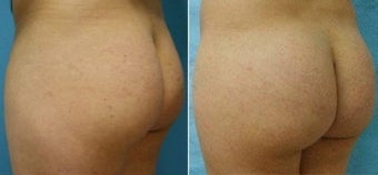 Buttock Enhancement before 110105