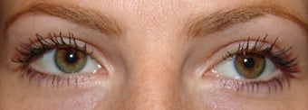 Upper Eyelid Blepharoplasty after 356800
