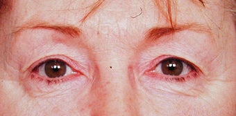 Blepharoplasty before 287437