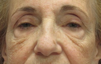 Browlift, ptosis repair, lower bleph and cheek lift before 433555