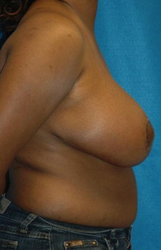 FEMMA-S Breast reduction and lift after 393389