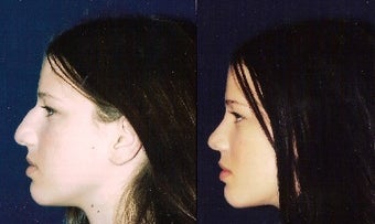 Septoplasty before 241673