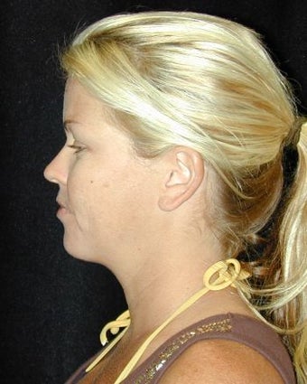 Liposuction of the Chin after 214684
