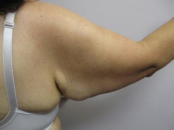 Arm Lift 389008