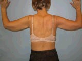 Arm Lift Surgery (Brachioplasty) before 151088