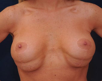 breast implant revision before 334113