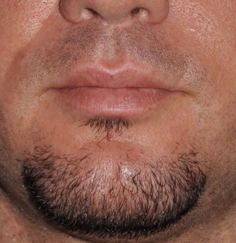 Chin Augmentation after 521701