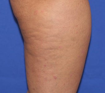 VASER Shape to Legs before 433061