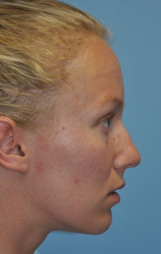 Rhinoplasty before 373784