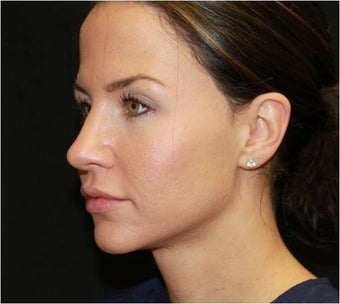 Ultherapy 434702