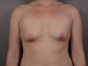 Breast Lift / Breast Augmentation before 291063
