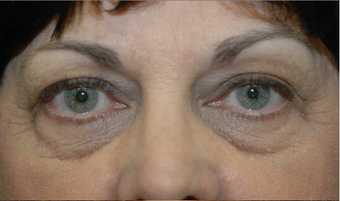 Lower blepharoplasty and fat grafting before 524914