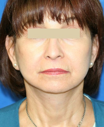 Facelift Gallery after 137142