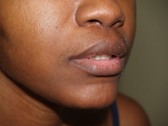 Upper Lip Lift after 405416