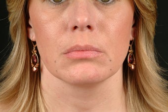 Botox 531606