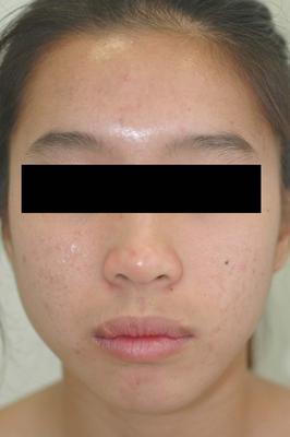 Laser Acne Treatment after 82970