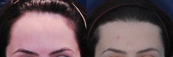 Forehead Reduction Surgery or Hairline Lowering Surgery after 323759