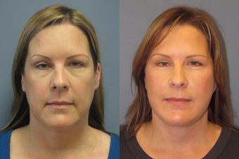 Lite Lift, liposuction of the neck, blue peel before 523484