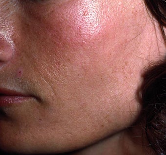 Facial Volumizing after 149211
