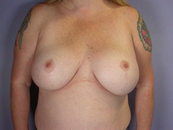 Breast Lift / Breast Augmentation after 291096