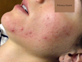Acne Treatment via Isolaz before 570309
