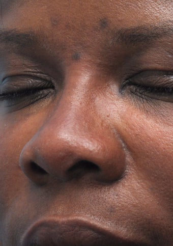 Non Surgical Rhinoplasty 407865